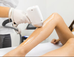 Laser-Haarentfernungsverfahren für die Beine der Frau mit der Diodenlasertechnik